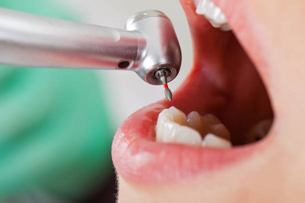 Emergency Dental Filling Replacement in OK